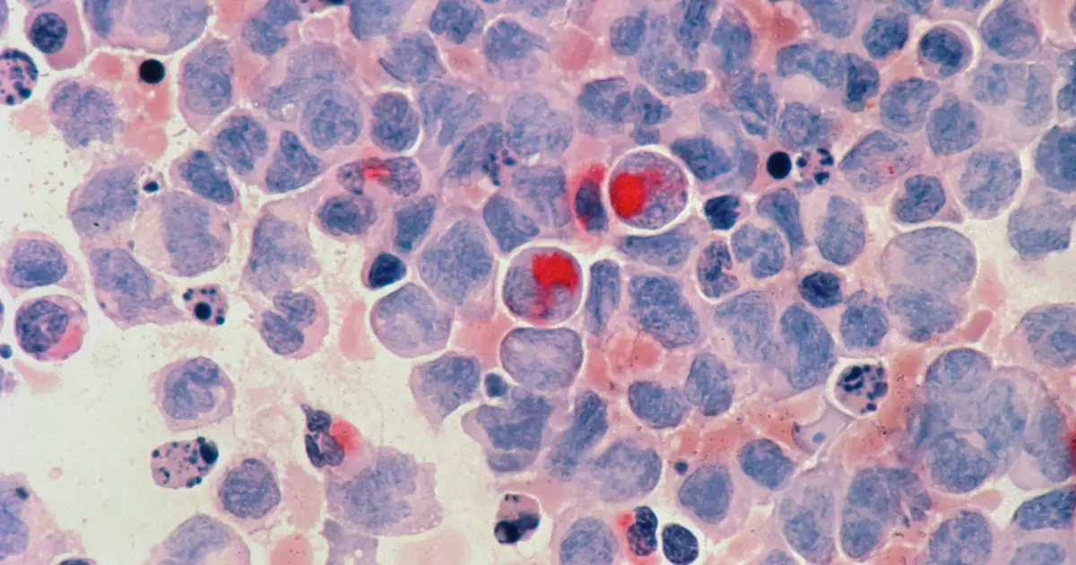 Mapping the diversity of chronic lymphocytic leukemia at single-cell resolution