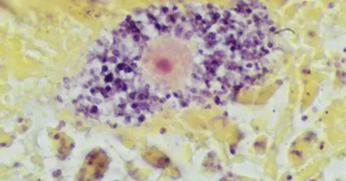 Macrophage 'molecular scissors' may drive obesity-linked inflammation and metabolic damage
