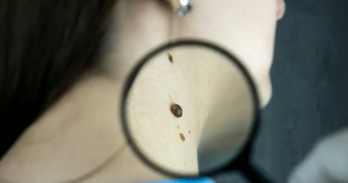 Researchers map the development and behavior of B cells in melanoma