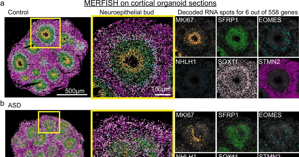 Patchy brain development may help explain autism's varied traits