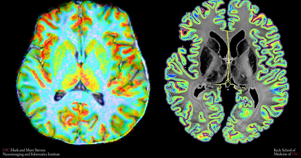 New MRI measure reveals how closely blood flow matches brain cells' energy needs