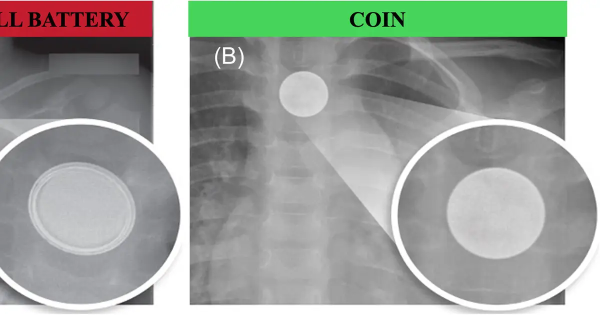 New button battery technology shows promise, but swallowing remains an emergency