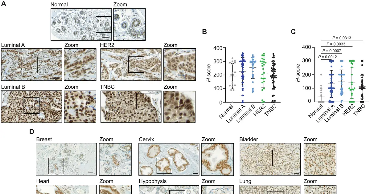 New mechanism behind breast cancer metastasis uncovered