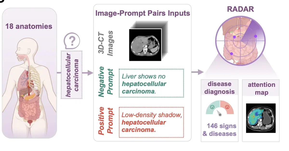 AI assistant learns from radiology reports to spot problems in abdominal scans
