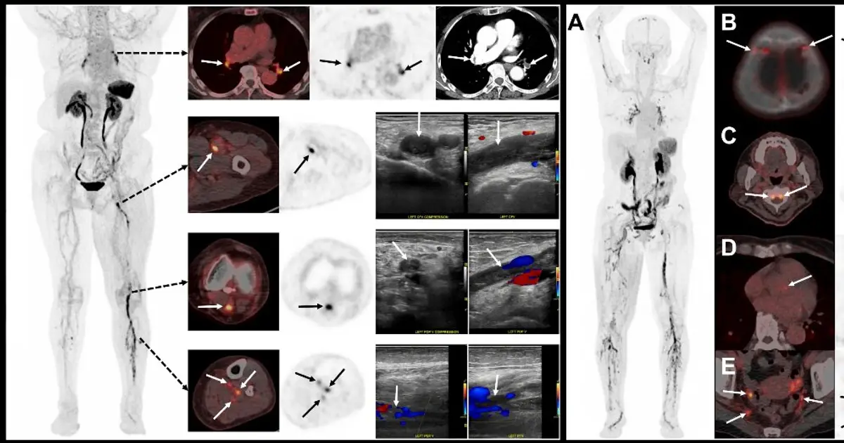 New PET tracer identifies DVT in legs and lungs