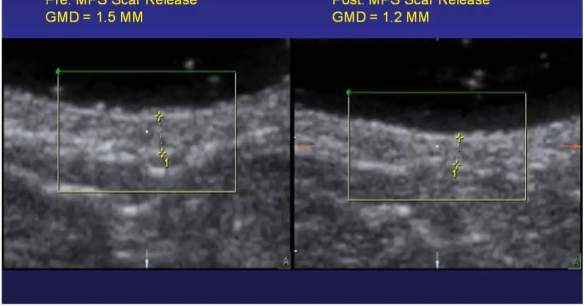 Study reports significant reduction in postsurgical scar depth following DC microcurrent stimulation