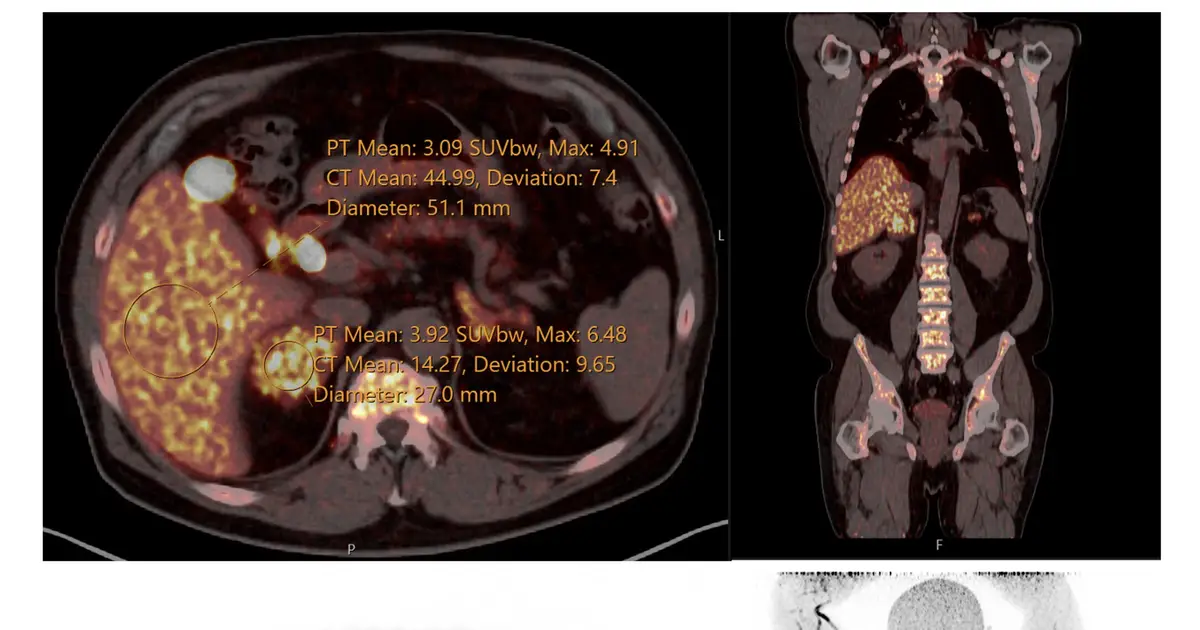 Novel radiotracer images overactive adrenal glands to avoid invasive primary aldosteronism procedure
