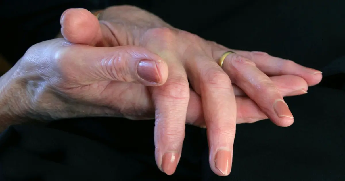 Finding new osteoarthritis medicines via AI and genetics