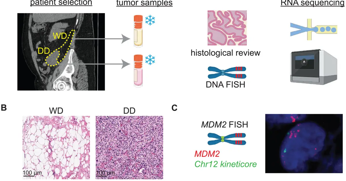 Protein 'switch' determines whether liposarcoma cells will become aggressive