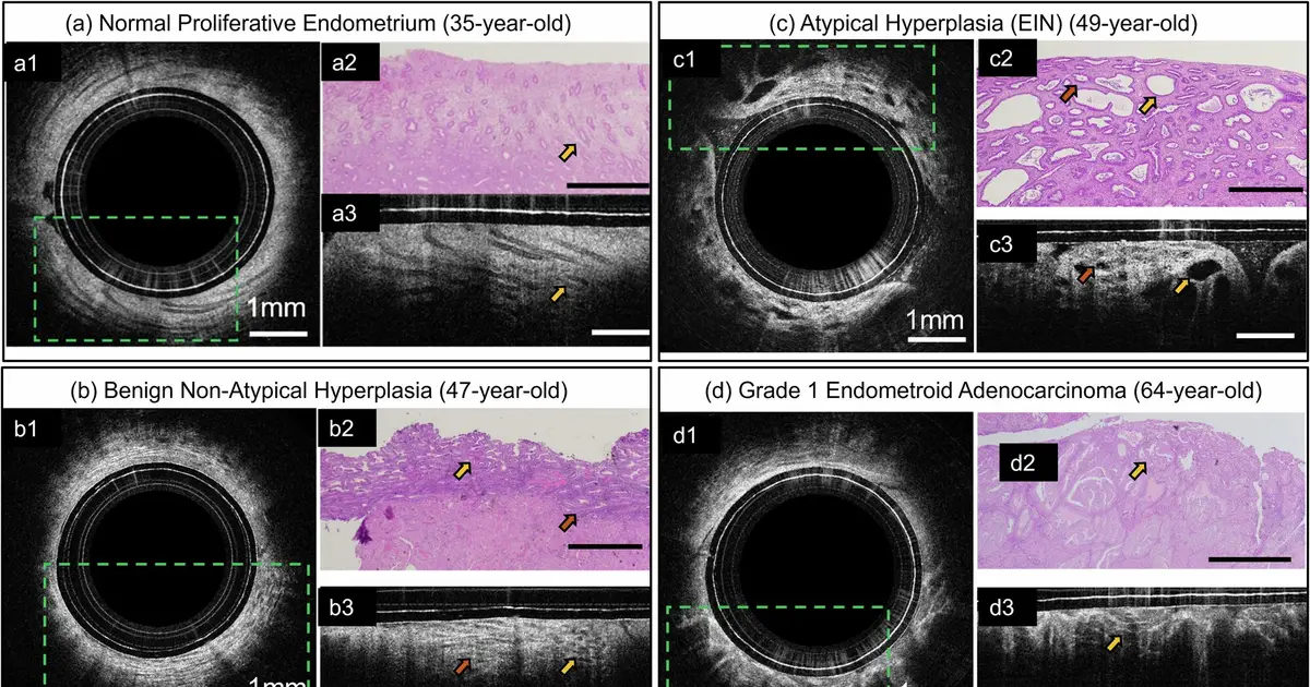 Quick optical biopsy could be early detection method for endometrial cancer