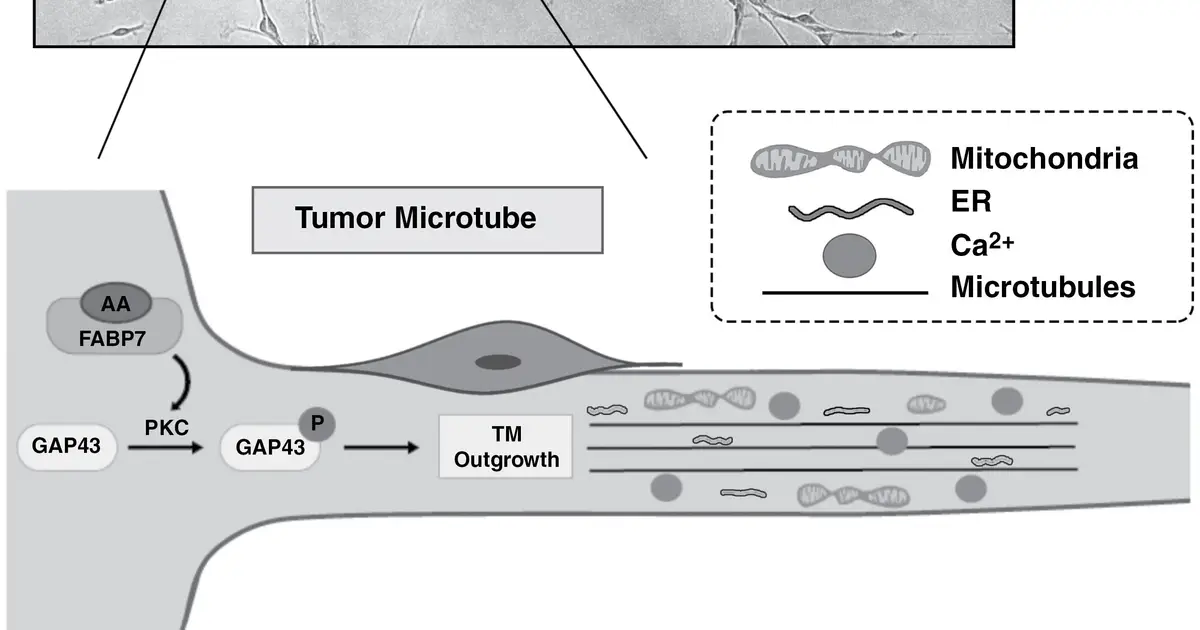 Researchers discover way to inhibit brain cancer's infiltration mechanism in glioblastoma