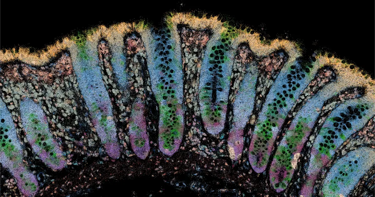 Even symptom-free IBD patients show gut cells primed for damage, study finds