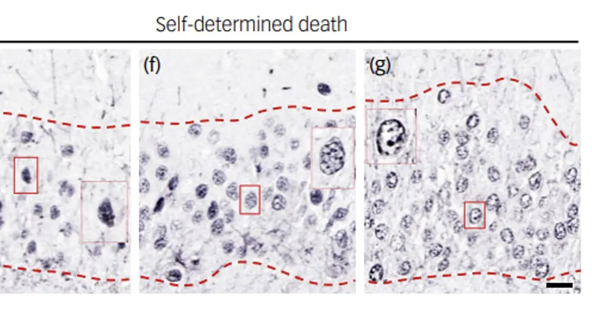 Researchers identify possible marker of suicidal thoughts