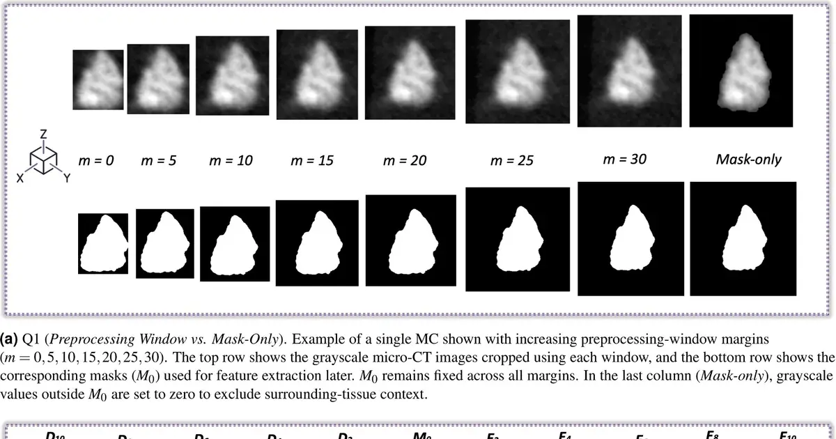 Researchers identify the tissue surrounding breast microcalcifications as a key source of diagnostic information