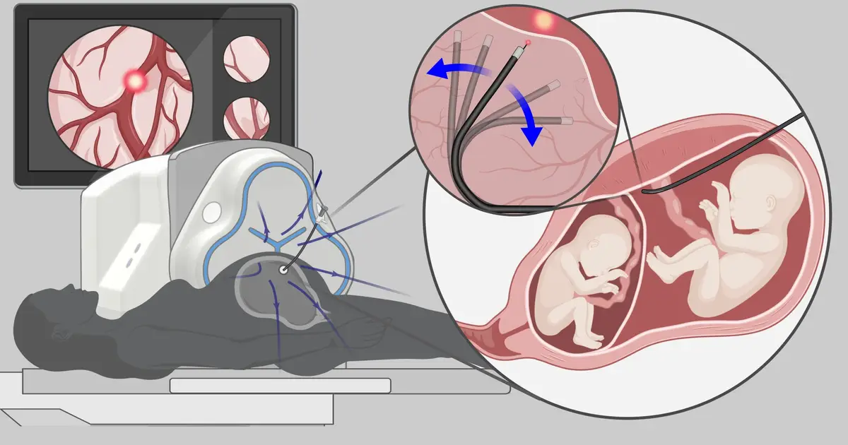 Robotic help in high-risk twin pregnancies: Panoramic guidance for a flexible laser scope