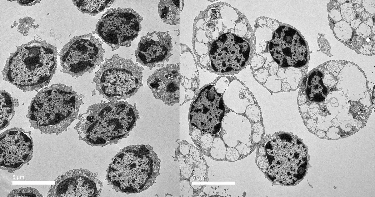 Scientists uncover cellular mechanism driving both rare childhood dementia and Alzheimer's disease