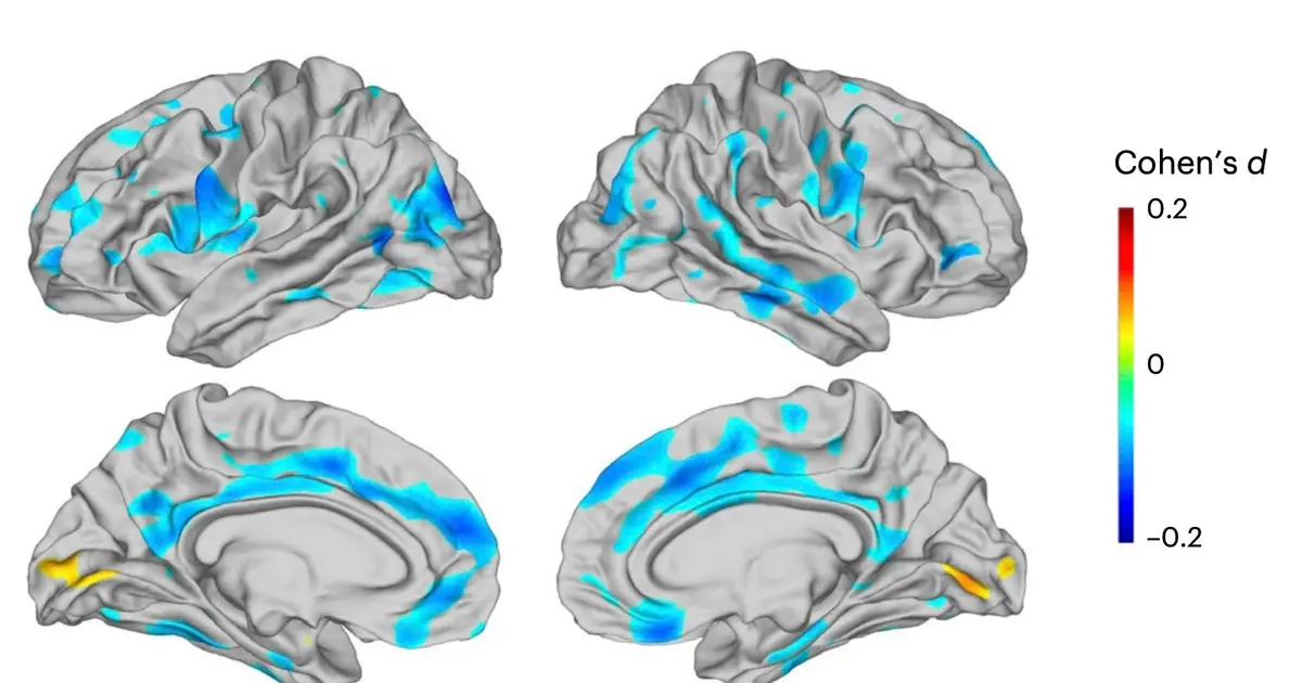 Large MRI analysis uncovers brain-region thinning tied to depression