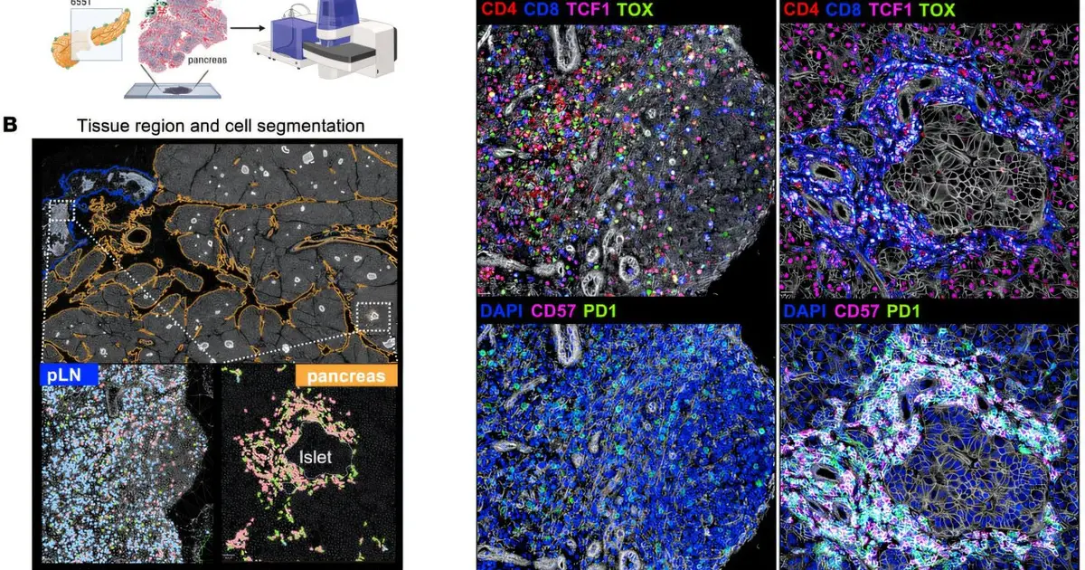 Immune cells that may help sustain type 1 diabetes attack identified