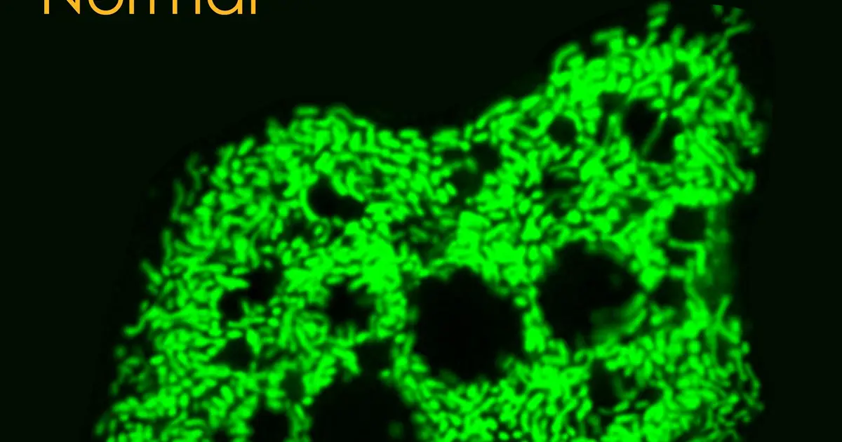EFHD1 may turn fatty liver disease into injury, with inhibition reducing scarring by up to 60%