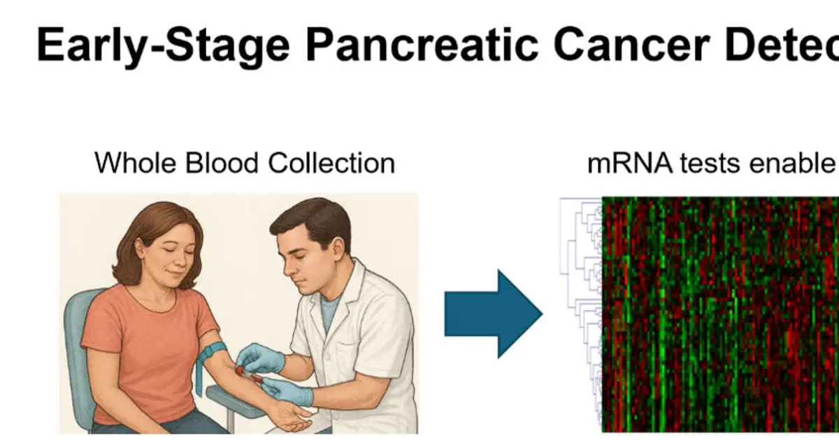 Blood gene test detects 90% of early-stage pancreatic cancers