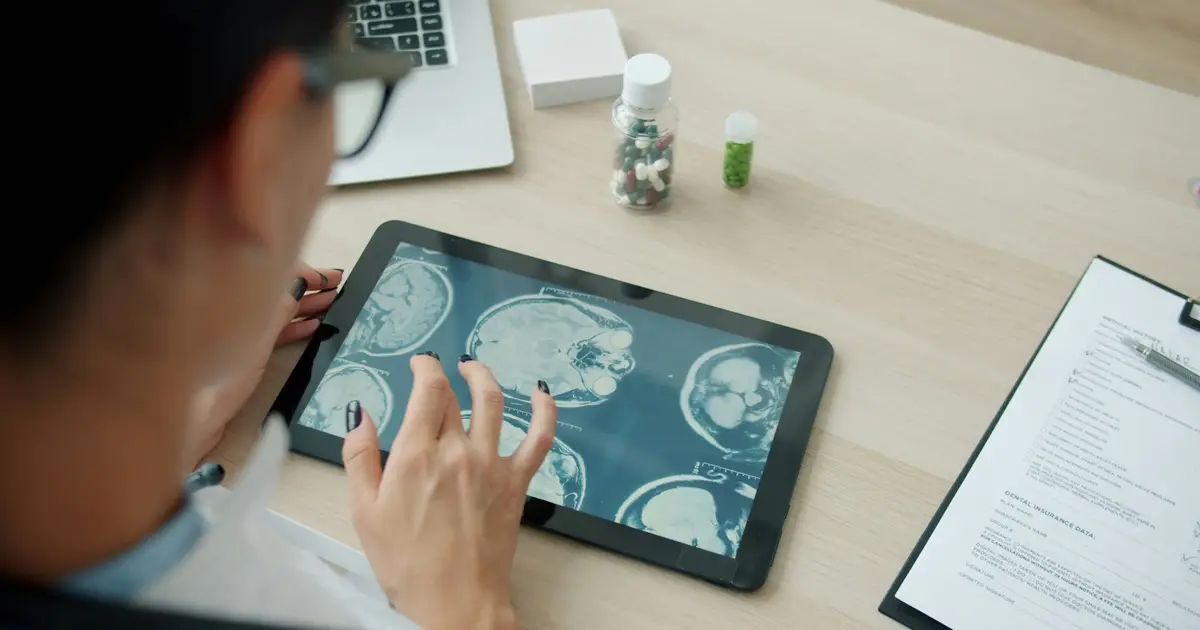 Stroke may change brain cells in ways that help gliomas grow