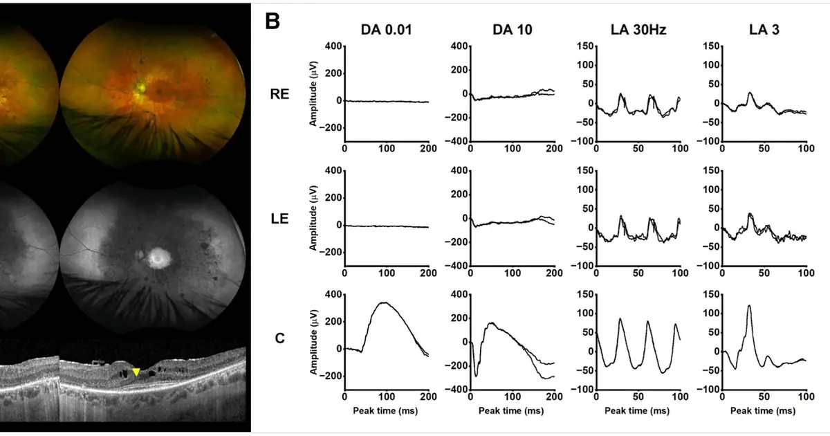 Unexpected link identified between rare metabolic disease gene and inherited blindness