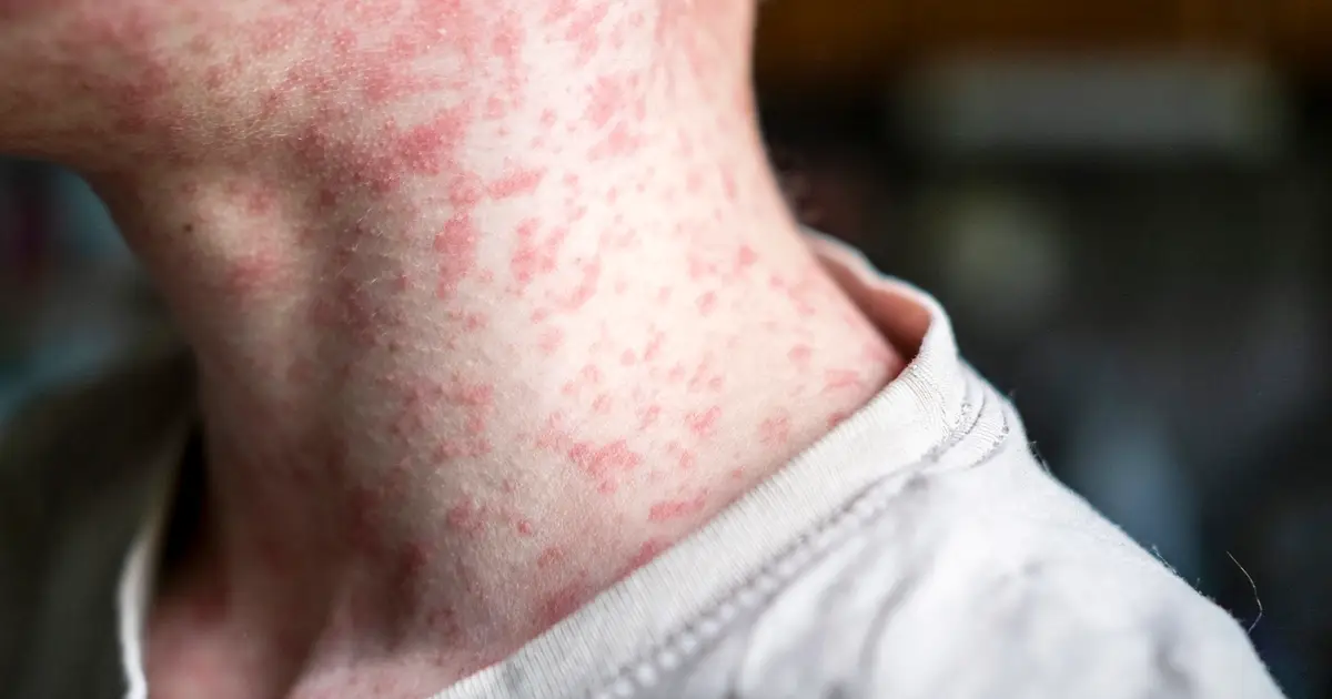 Measles Infection Count in January Topped Total Cases in 2023 and 2024 Combined
