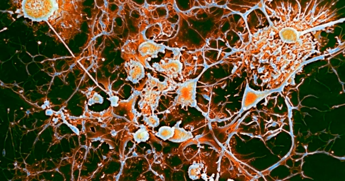 Best treatment for multiple sclerosis may be antivirals