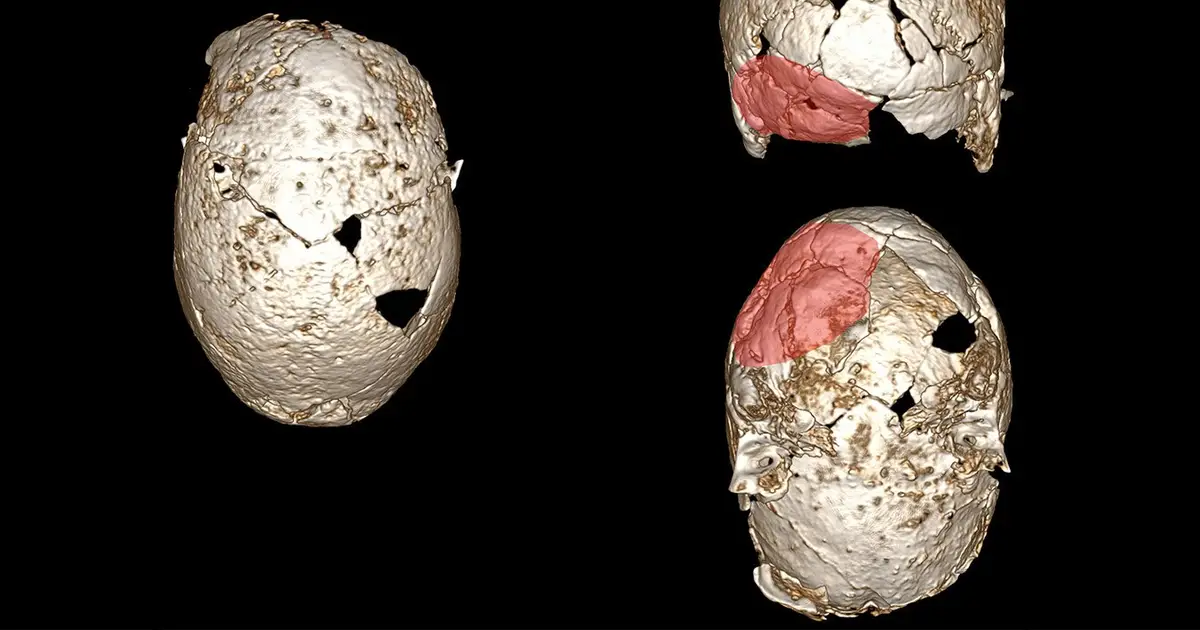 Flat head syndrome discovered in Iron Age skeletons