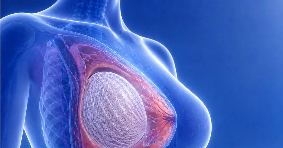 Breast-augmentation method uses your own fat in dissolving scaffolds