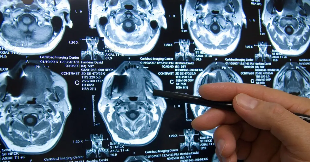 Depression doesn’t shrink the brain like we thought it did