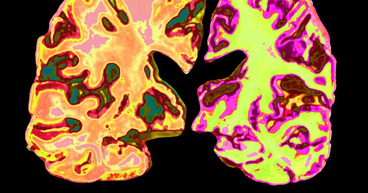 Should we all be taking low doses of lithium to prevent Alzheimer’s?
