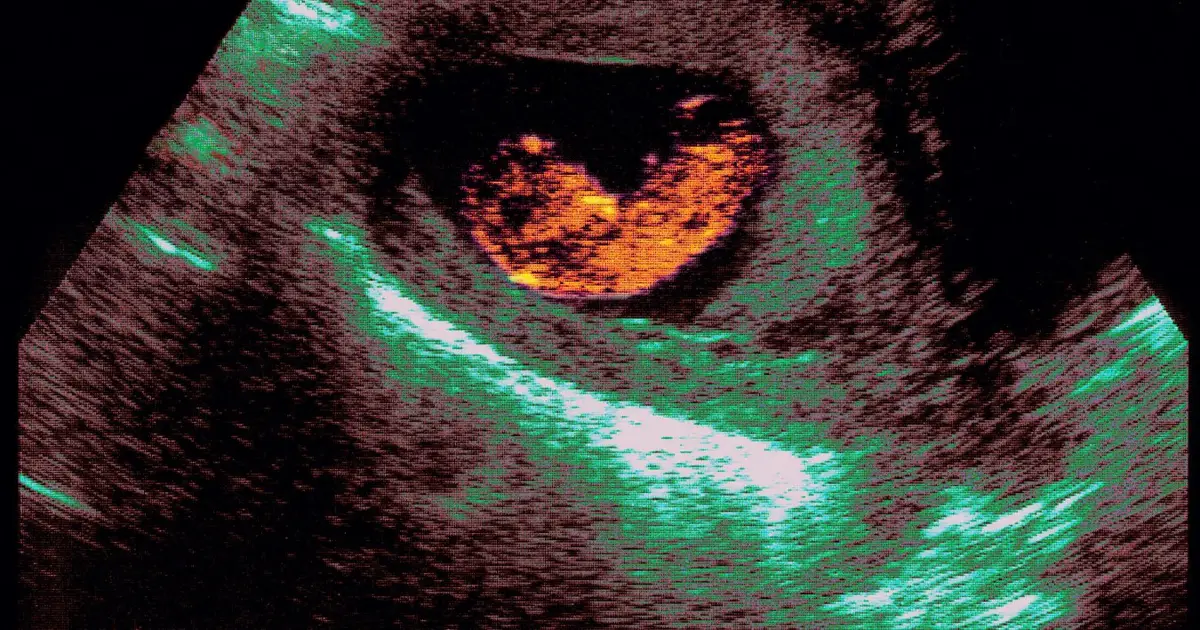 How older siblings may shape sexual orientation via mother’s immune system