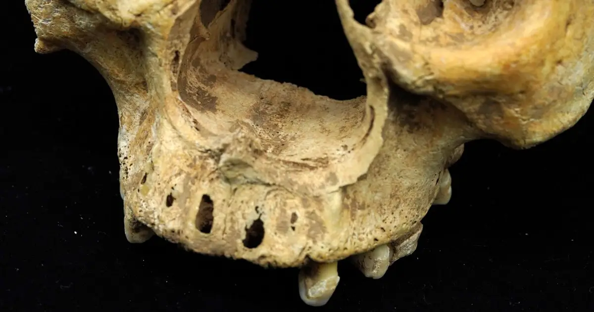 Ancient skeleton shows woman in imperial China had her nose amputated