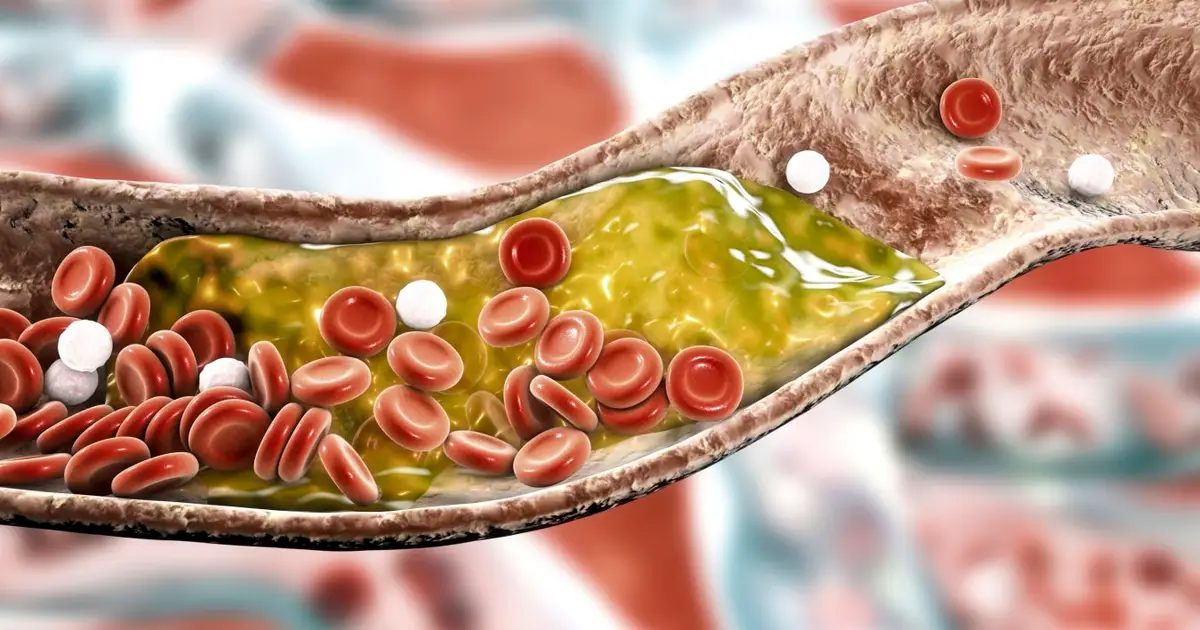 Nearly 1 in 10 young adults could have fatty, narrow arteries