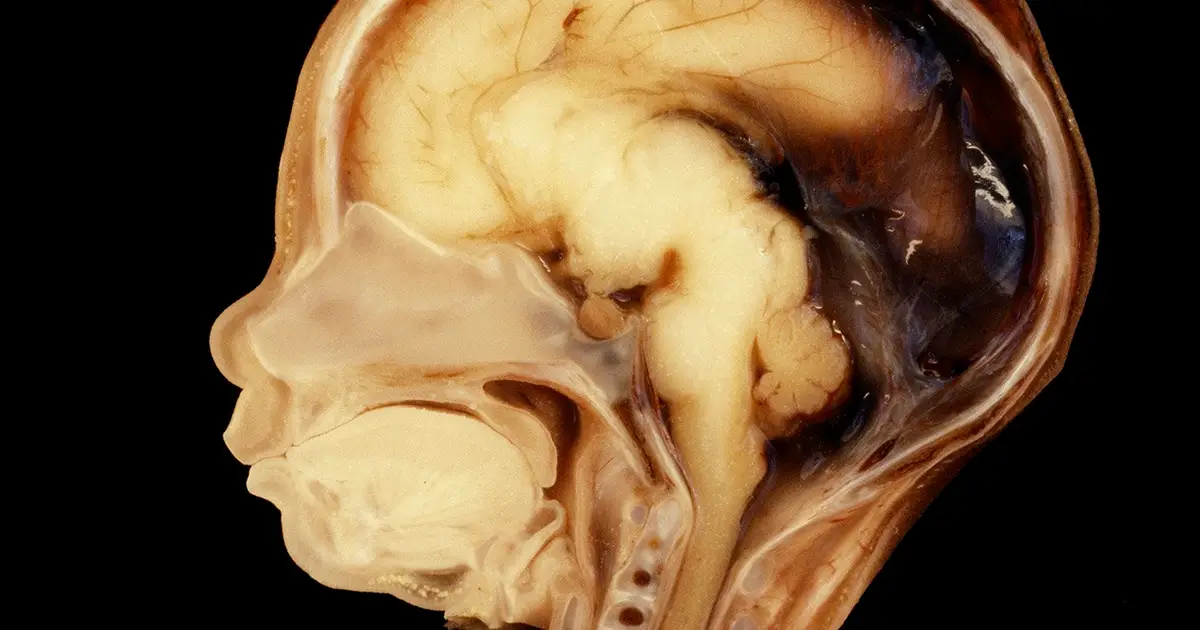 What are microchimeric cells doing to our brain?
