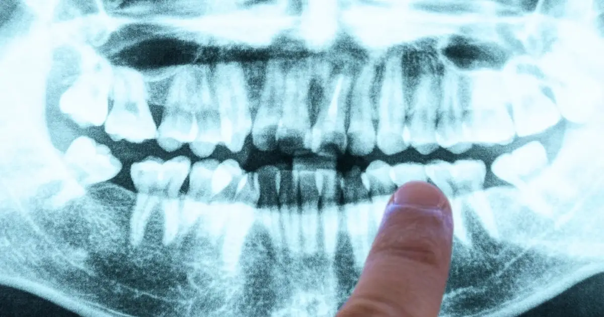 Your Gums May Be Quietly Hinting at a Future Health Risk