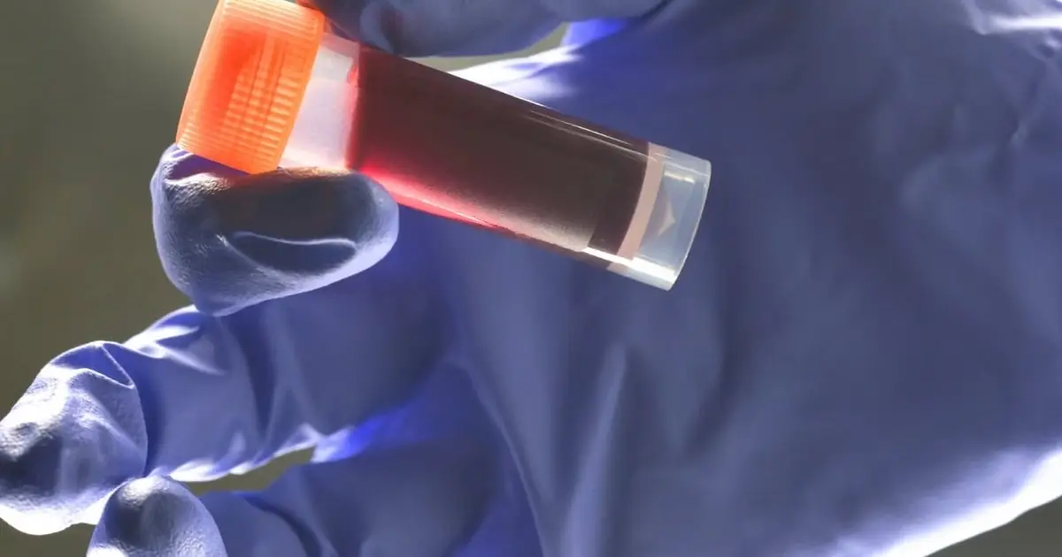 Your Blood Type Affects Risk of Early Stroke, Study Reveals
