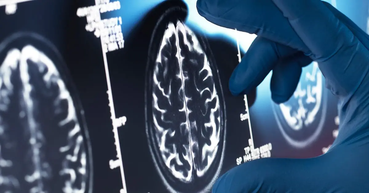 Brain Scans Reveal a Striking Similarity Between Schizophrenia And Bipolar Disorder