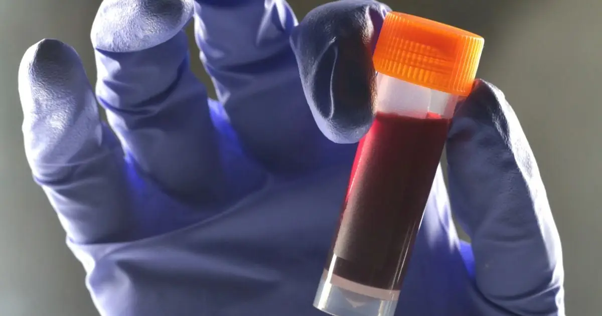 One Blood Type Appears to Carry Higher Risk of Type 2 Diabetes