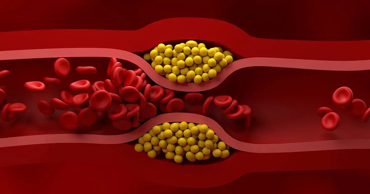 US Cardiologists Issue New Guidelines For How to Manage Cholesterol