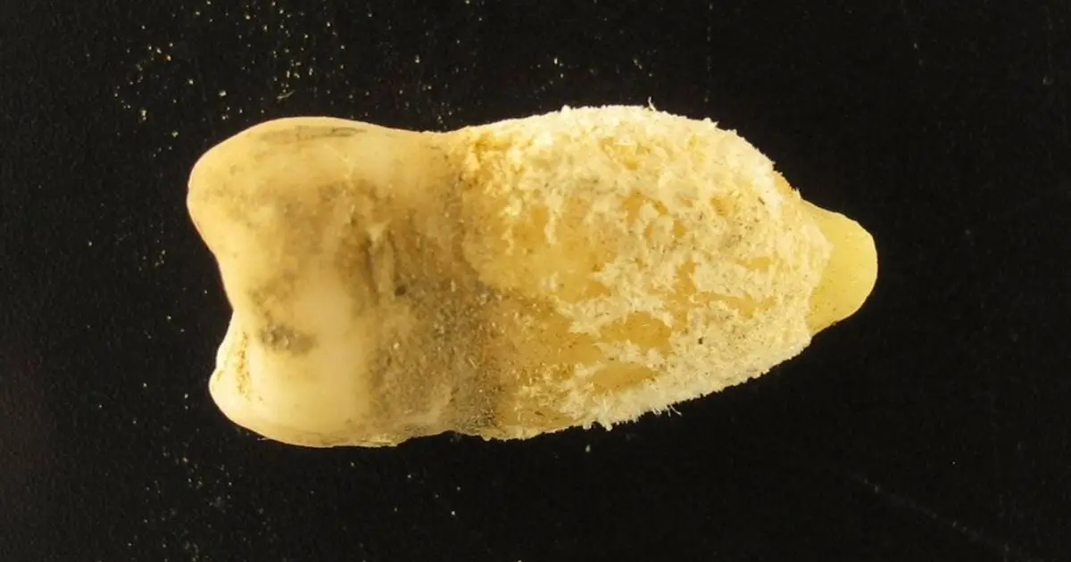 A Bolivian Mummy's Tooth Is Rewriting The History of Scarlet Fever