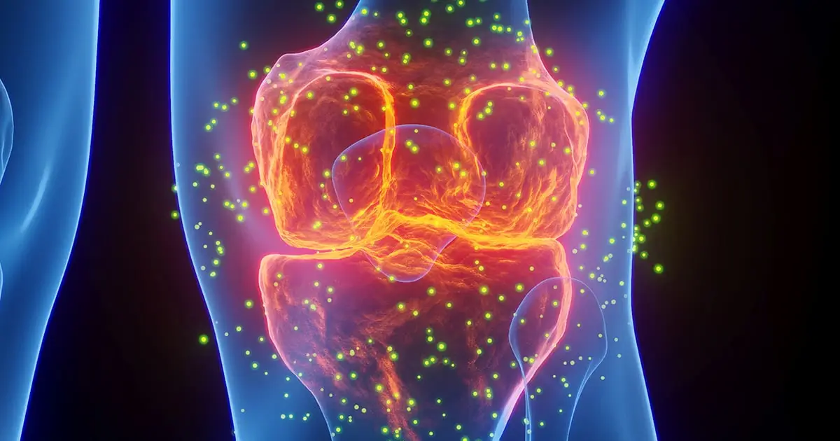 Common Gout Medications Linked to Lower Risk of Heart Attack And Stroke
