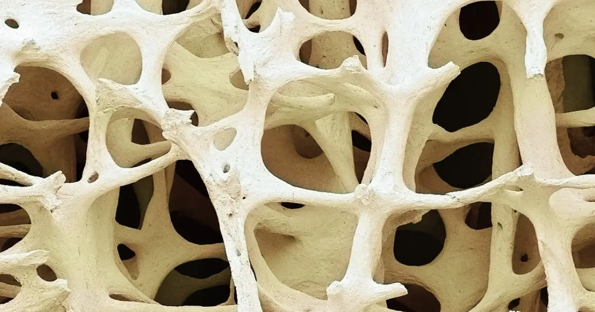 A Silent Bone Condition Affects 40% of Adults. It May Warn of Osteoporosis.