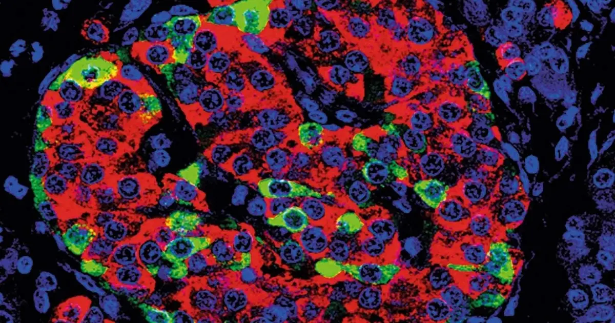 Stem Cells Can Revive Insulin Production in Type 1 Diabetes, Trials Show