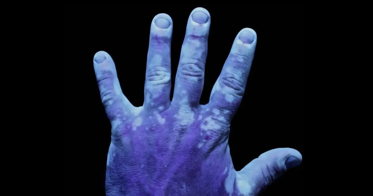 The Stigma Around This Common Skin Condition Runs Deeper Than You Think