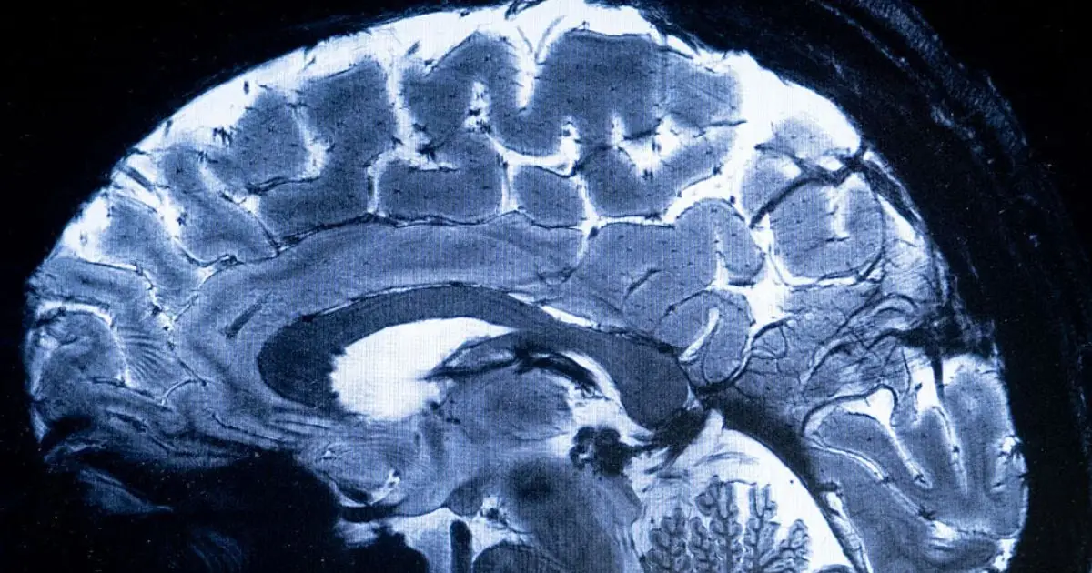 Experimental Brain 'Pacemakers' May Rewire Circuits Linked to Depression