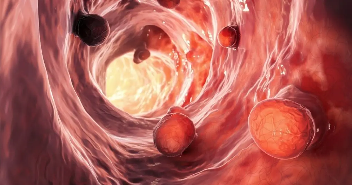 Gut Microbiome Could Remain Disrupted For Over a Decade After Polyp Removal