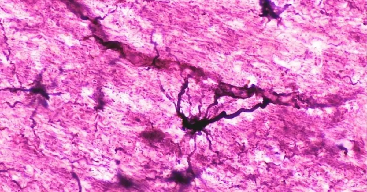 Two People With Severe Autoimmune Disease in Remission After Immune 'Reset'