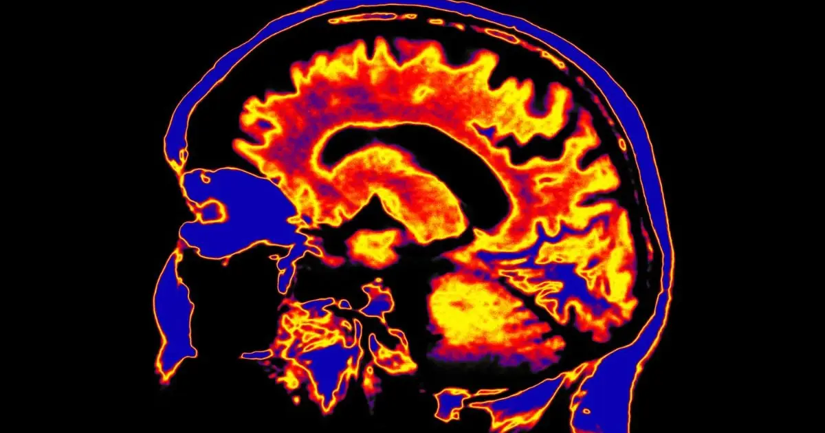 Scientists Discover a Potential Driver of Chronic Fatigue Syndrome Hiding Deep in The Brain